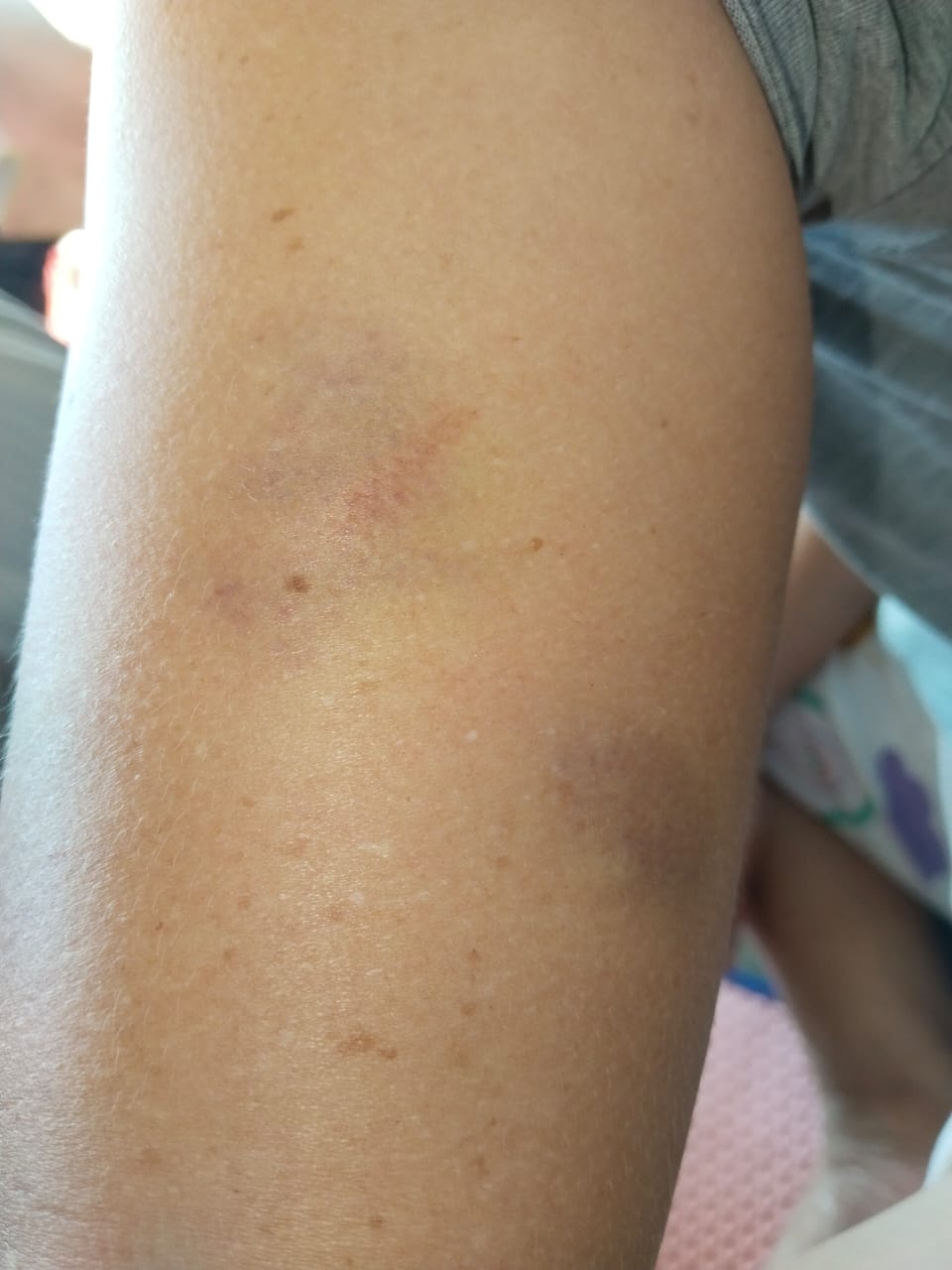 Ibu Rumah Tangga di Tanjungpinang Jadi Korban Pengeroyokan, Korban Keluhkan Lambatnya Proses Hukum